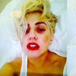 Gaga unveils effects of a poled head injury at Auckland concert. (Twitter)