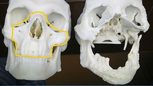 Computerized tomography  courtesy of the Cancer Center and Institute of Oncology in Gliwice, Poland, shows the skull of a 33-year-old Polish man after it was damaged in a work accident, right,  alongside the healthy skull of another person. 